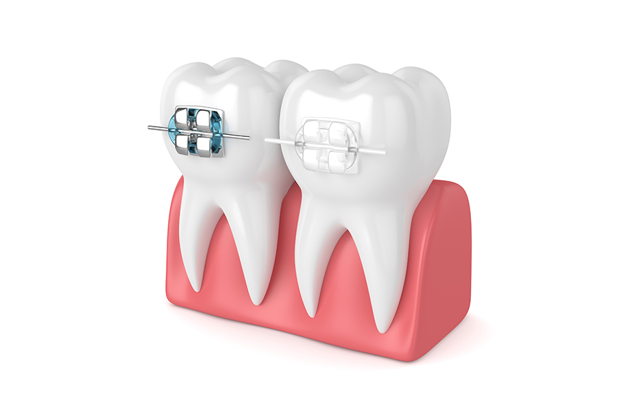 部分矯正（MTM）