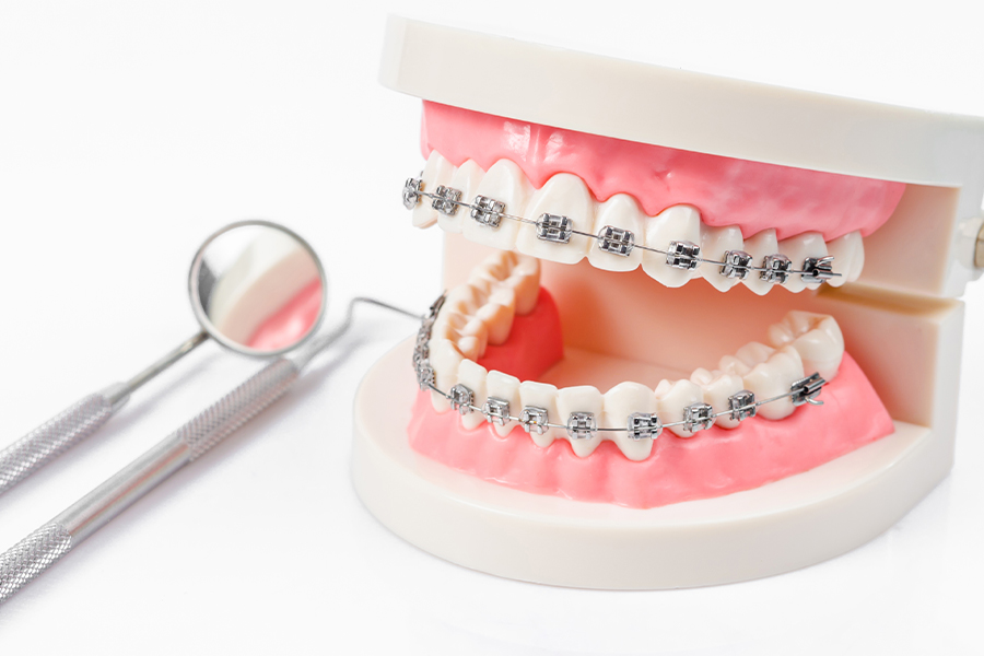 ワイヤー矯正（マルチブラケット）
